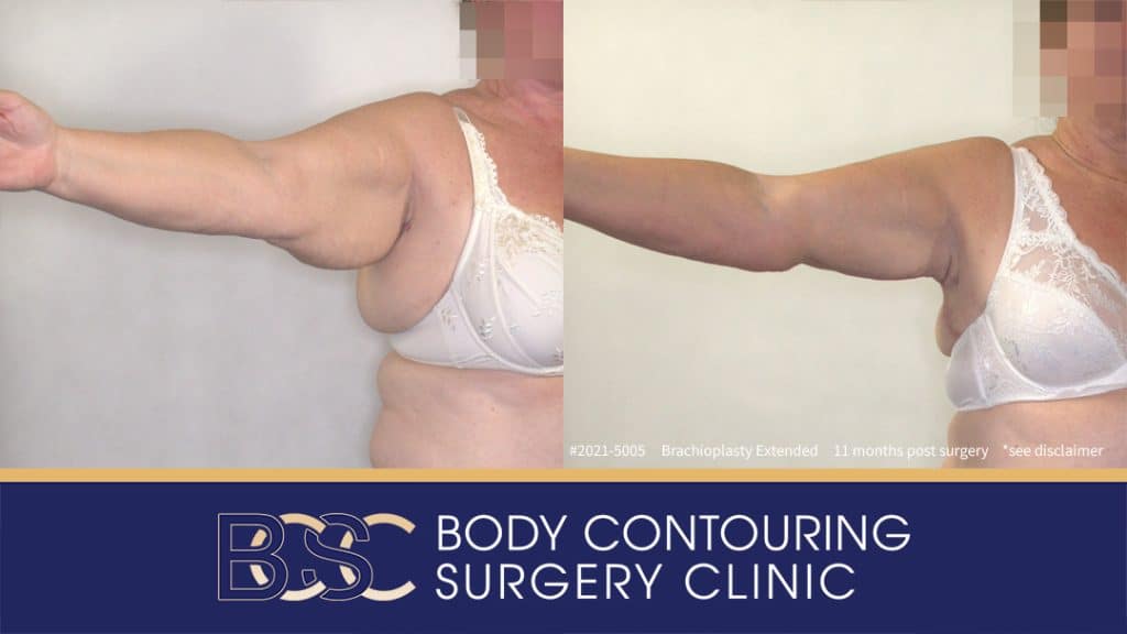 Extended Brachioplasty Assisted by VASER Liposuction (Patient 2021-5005) - Right