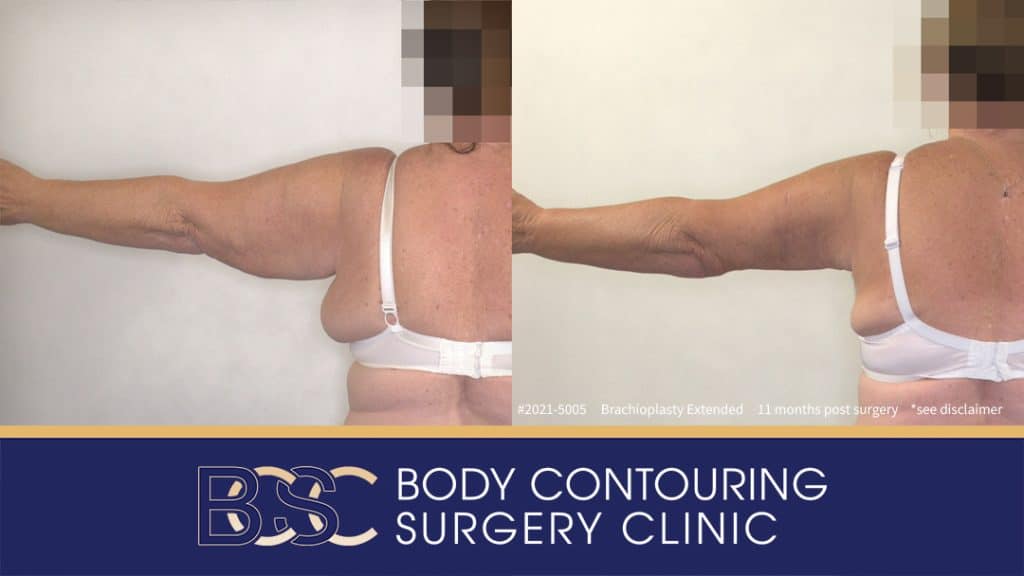 Extended Brachioplasty Assisted by VASER Liposuction (Patient 2021-5005) - Back