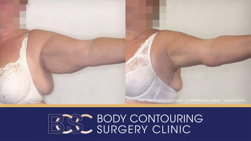Extended Brachioplasty Assisted by VASER Liposuction (Patient 2021-5005) - Left