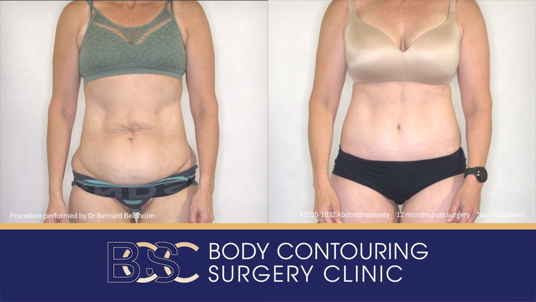 Patient 2020-1032 Abdominoplasty Post Weight Loss - Front