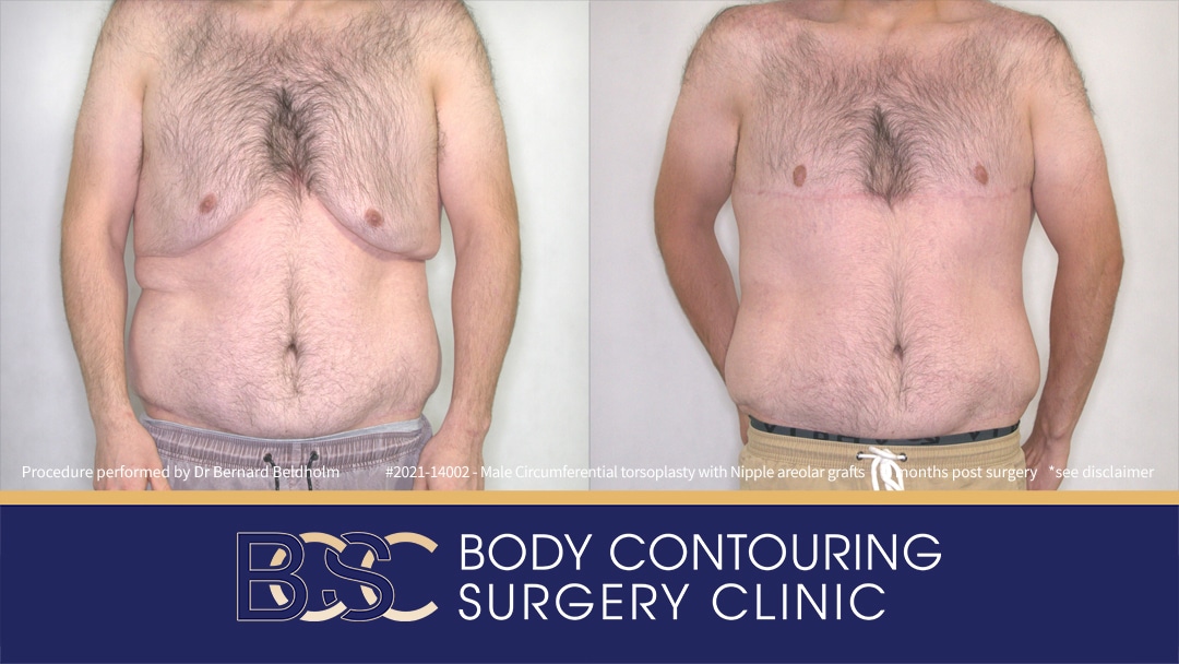 Male Circumferential Torsoplasty (Upper Thoracic Lift) with Nipple Areolar Grafts (Patient 2021-14002) 6 Months Post Surgery - Front