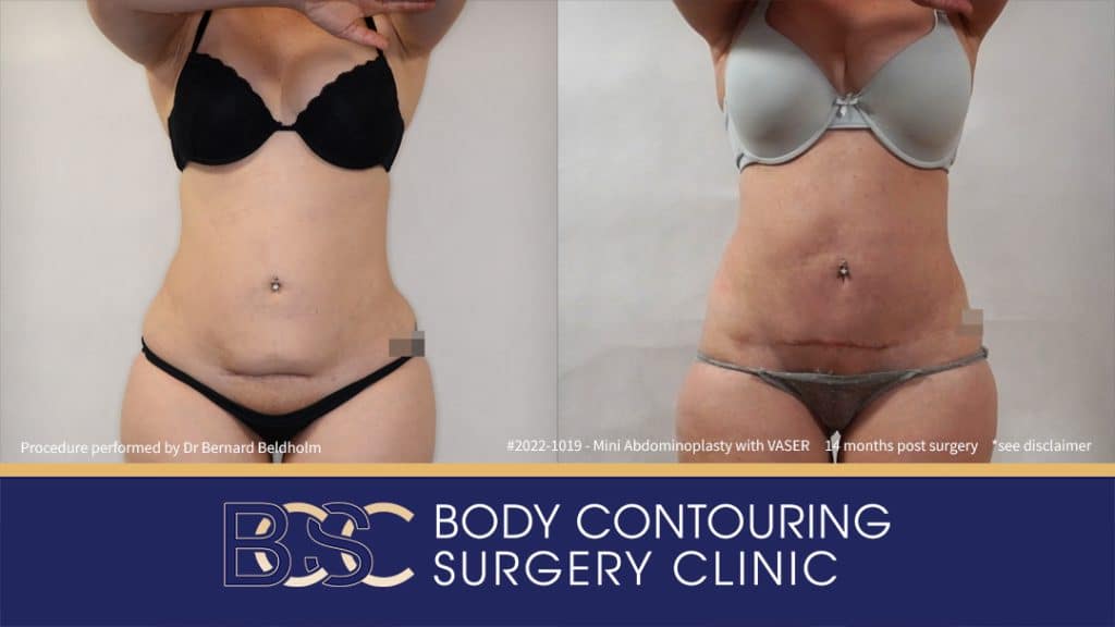 Mini Abdominoplasty with VASER Liposuction (Patient 2022-1019) - Front