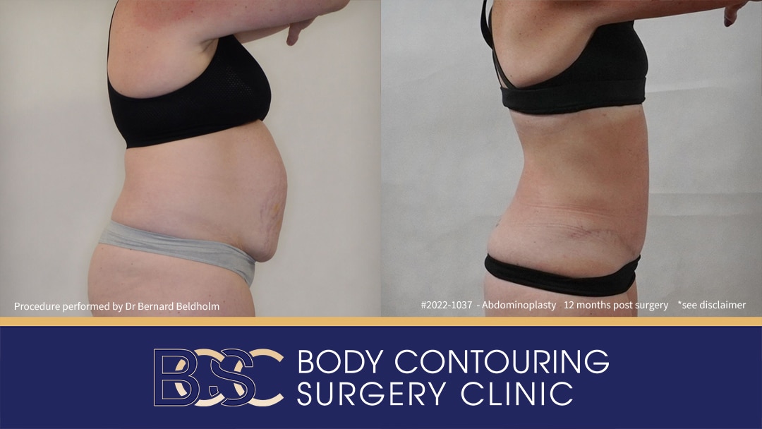 Full Abdominoplasty Including VASER Liposuction (Patient 2022-1037) - Side