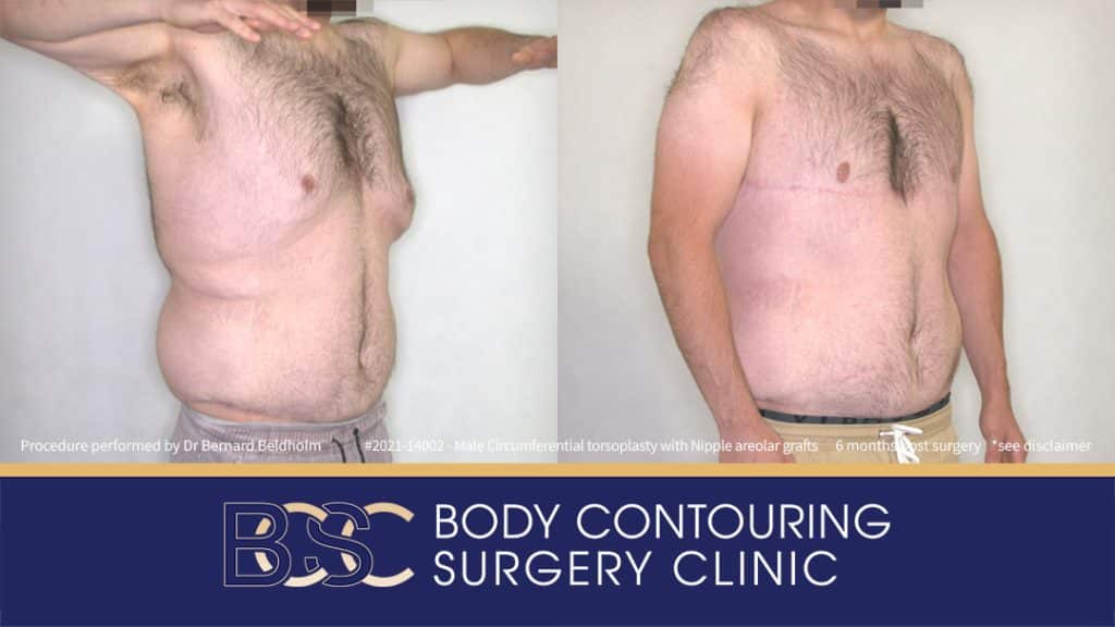 Male Circumferential Torsoplasty (Upper Thoracic Lift) with Nipple Areolar Grafts (Patient 2021-14002) 6 Months Post Surgery - Left
