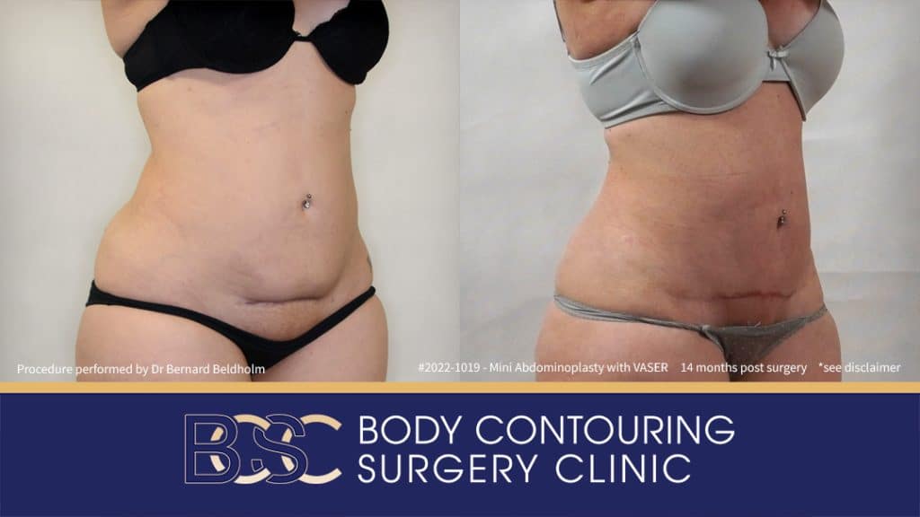 Mini Abdominoplasty with VASER Liposuction (Patient 2022-1019) - Left