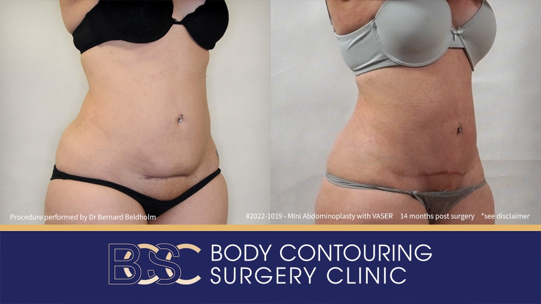 Mini Abdominoplasty with VASER Liposuction (Patient 2022-1019) - Left