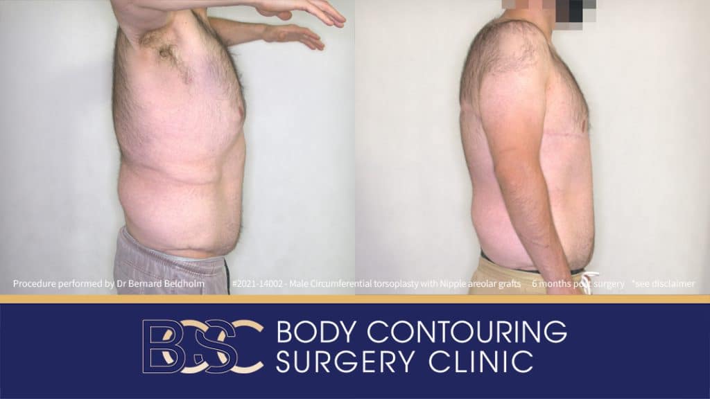 Male Circumferential Torsoplasty (Upper Thoracic Lift) with Nipple Areolar Grafts (Patient 2021-14002) 6 Months Post Surgery - Side