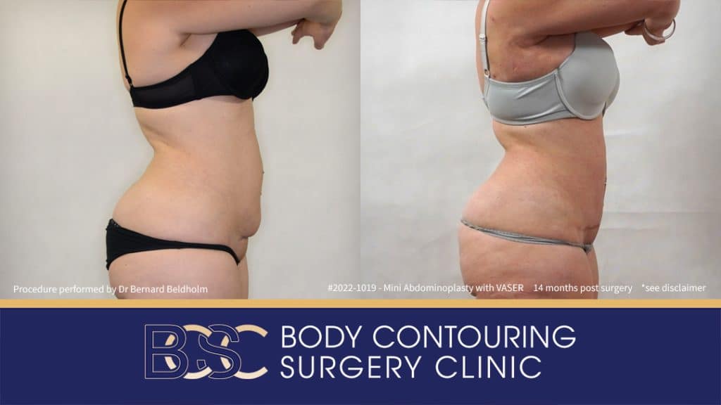 Mini Abdominoplasty with VASER Liposuction (Patient 2022-1019) - Side