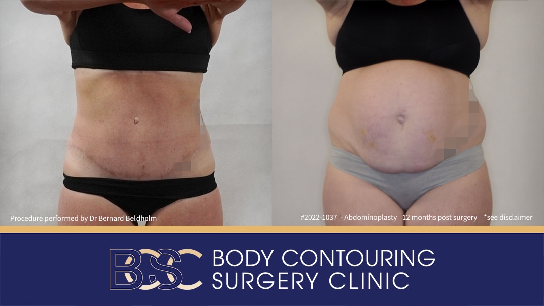 Full Abdominoplasty Including VASER Liposuction (Patient 2022-1037) - Front