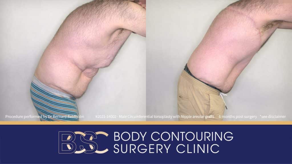 Male Circumferential Torsoplasty (Upper Thoracic Lift) with Nipple Areolar Grafts (Patient 2021-14002) 6 Months Post Surgery - Bend