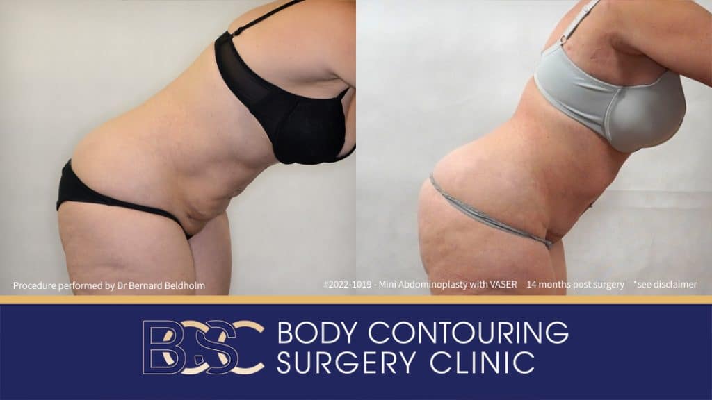 Mini Abdominoplasty with VASER Liposuction (Patient 2022-1019) - Bend