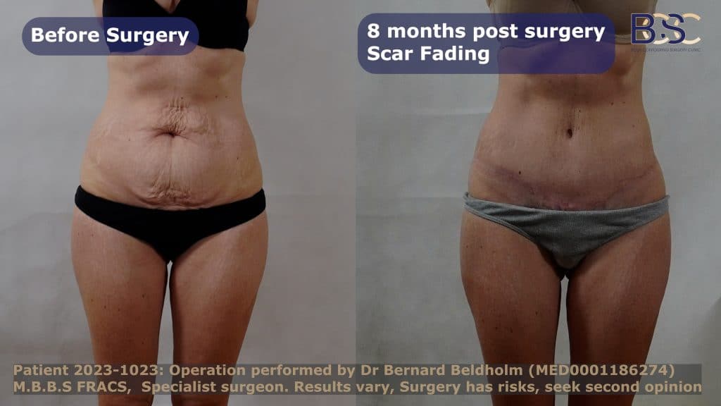 Surgical scar after tummy tuck procedure | scar treatments