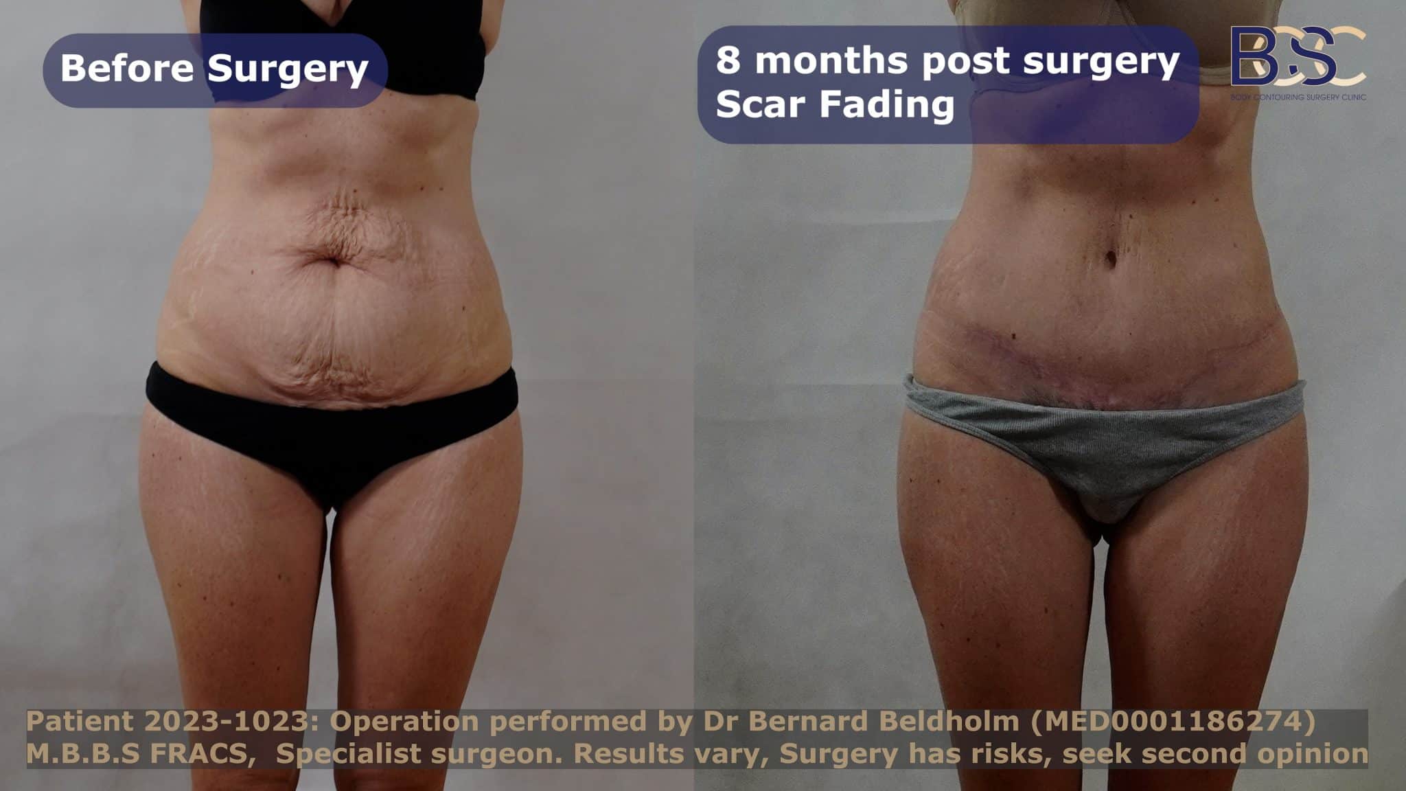 surgical scar after tummy tuck procedure / scar treatments