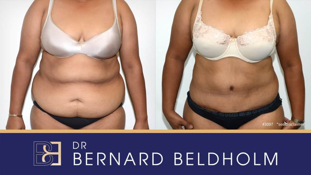 Standard tummy tuck incision | Abdominoplasty | Dr Bernard Beldholm