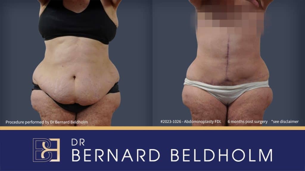 Horizontal and vertical scar | Dr Bernard Beldholm