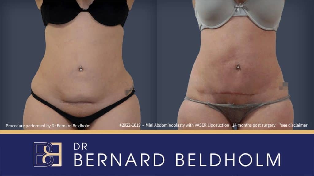 Mini Abdominoplasty | Dr Bernard Beldholm