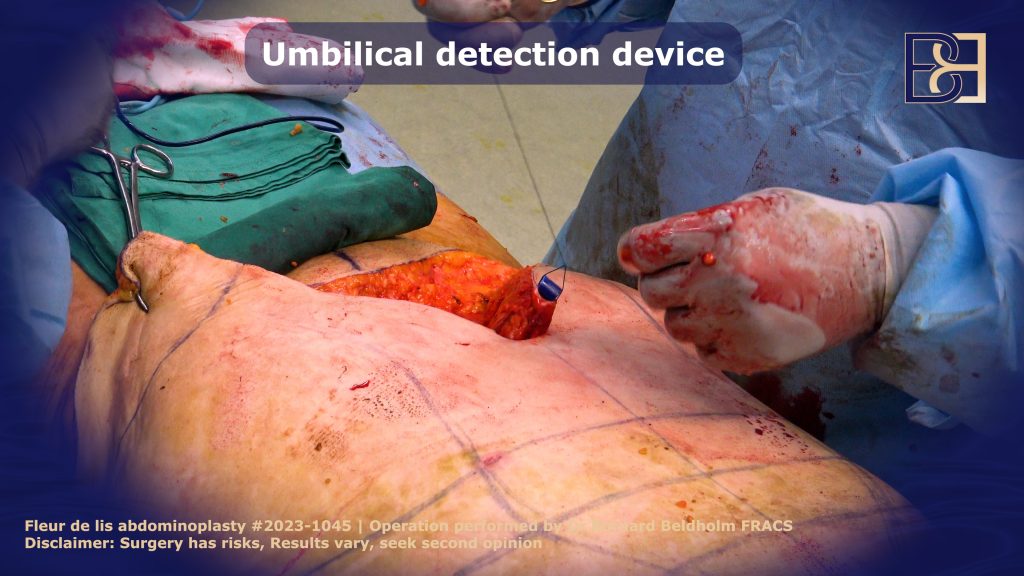 Umbilical detection device | Dr Beldholm