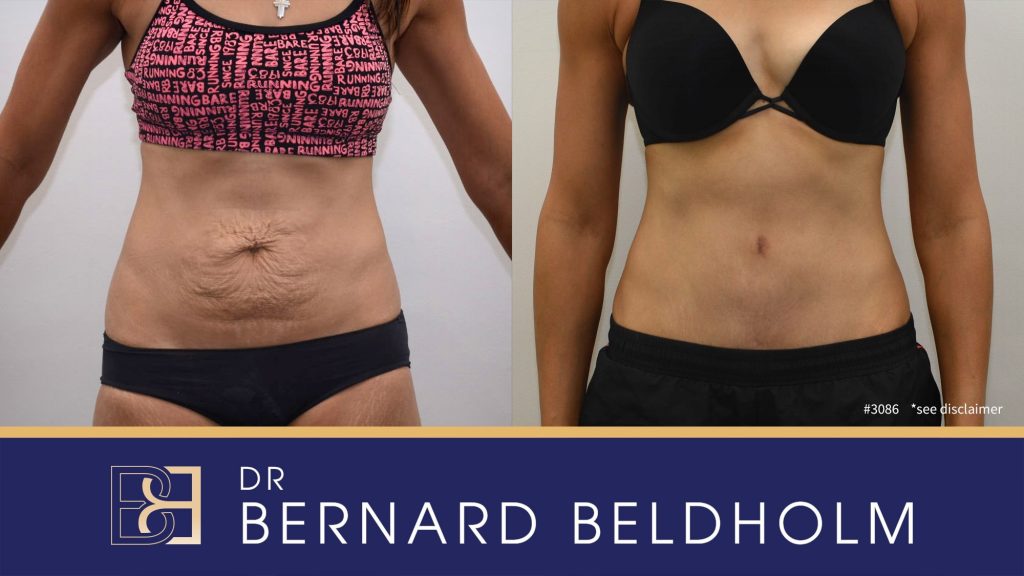 Tummy tuck procedure will remove excess fat and skin after pregnancy | Dr Beldholm