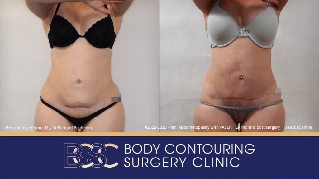 Mini abdominoplasty with VASER liposuction