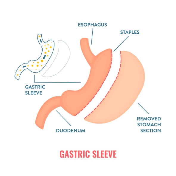 Sleeve gastrectomy