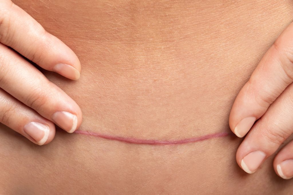 Tummy tuck scar | Dr Beldholm