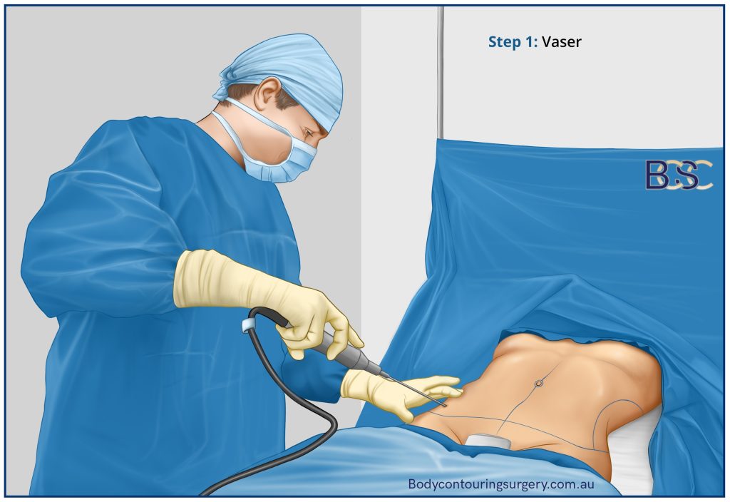 VASER liposuction