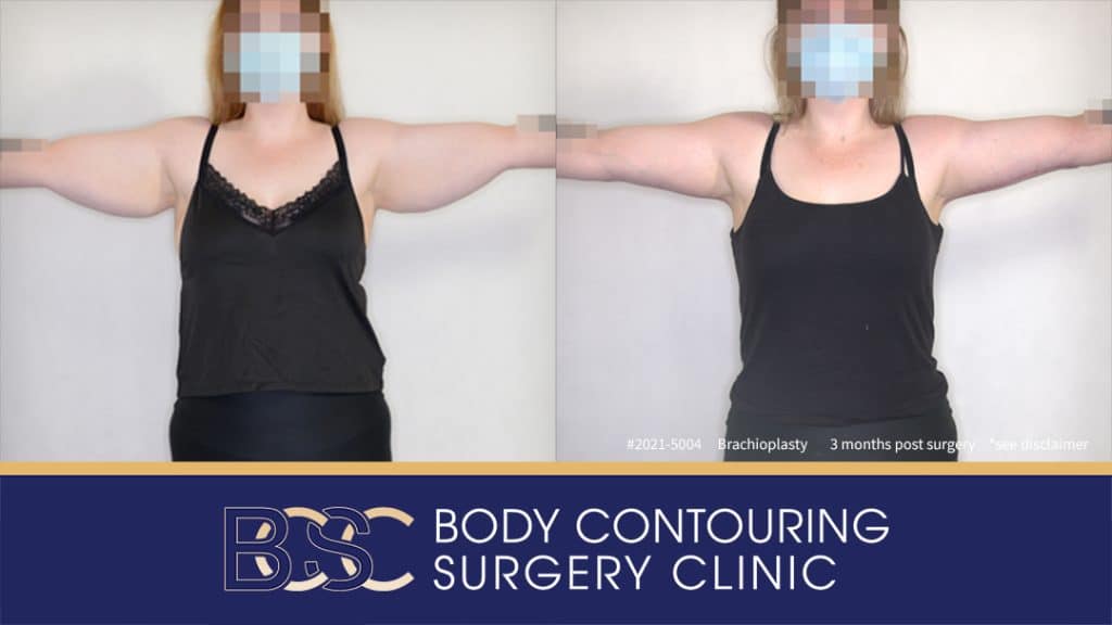 Patient 2021-5004 Brachioplasty Assisted by VASER Liposuction - Front