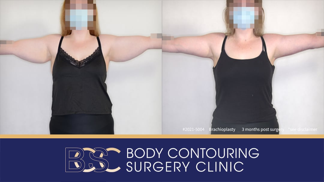 Patient 2021-5004 Brachioplasty Assisted by VASER Liposuction