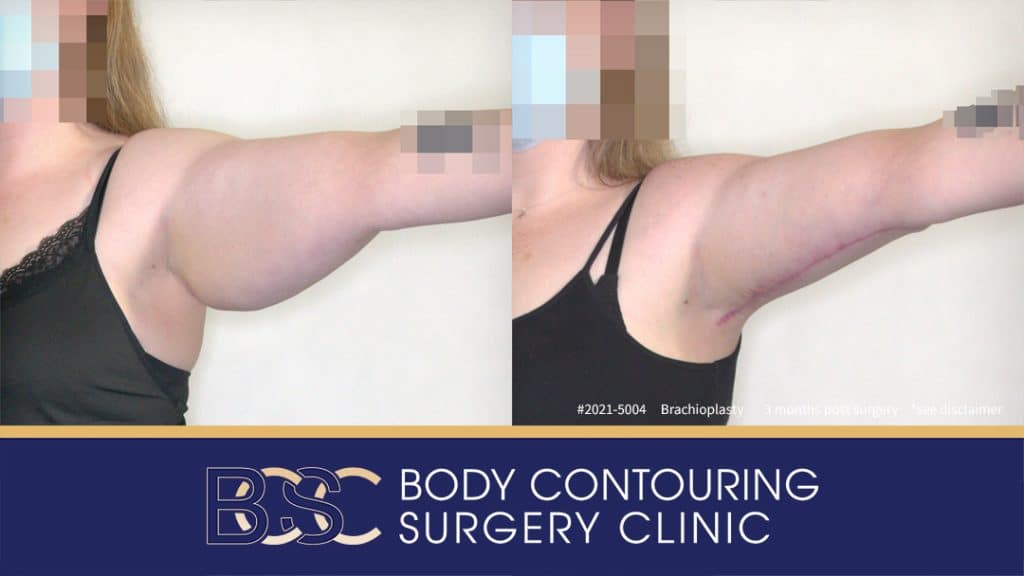 Patient 2021-5004 Brachioplasty Assisted by VASER Liposuction - Left