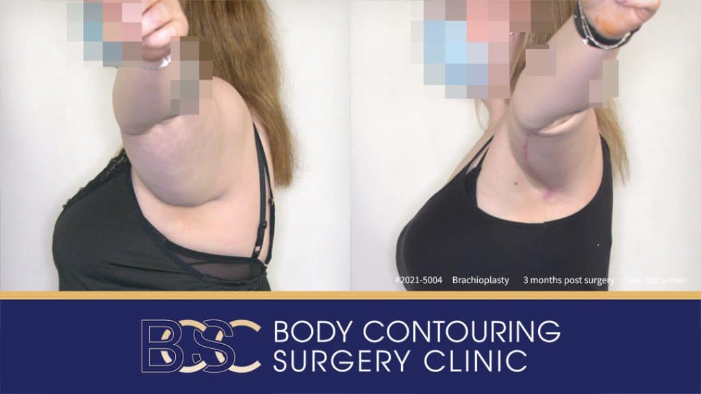 Patient 2021-5004 Brachioplasty Assisted by VASER Liposuction - Side