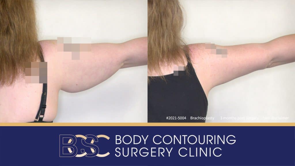 Patient 2021-5004 Brachioplasty Assisted by VASER Liposuction - Right