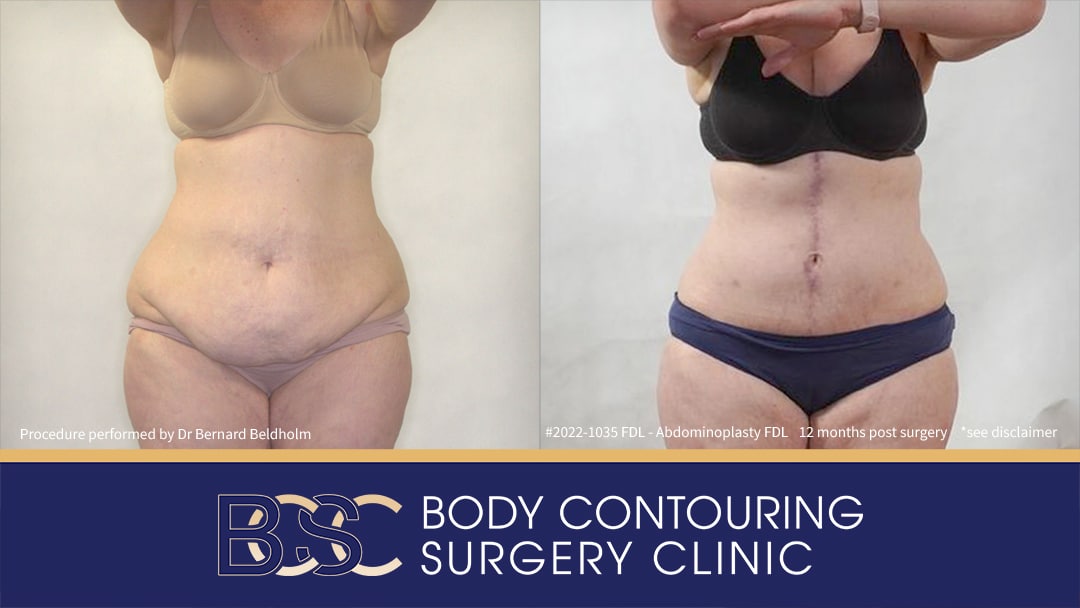 Patient 2022-1035 Fleur de Lis Abdominoplasty Including VASER Liposuction - Front