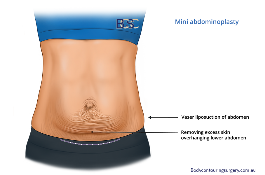 Mini abdominoplasty plastic surgery