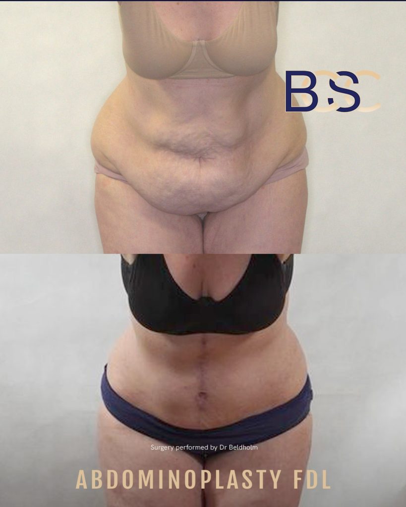 Fleur de lis abdominoplasty