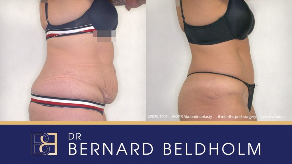 Cosmetic procedure | Dr Beldholm