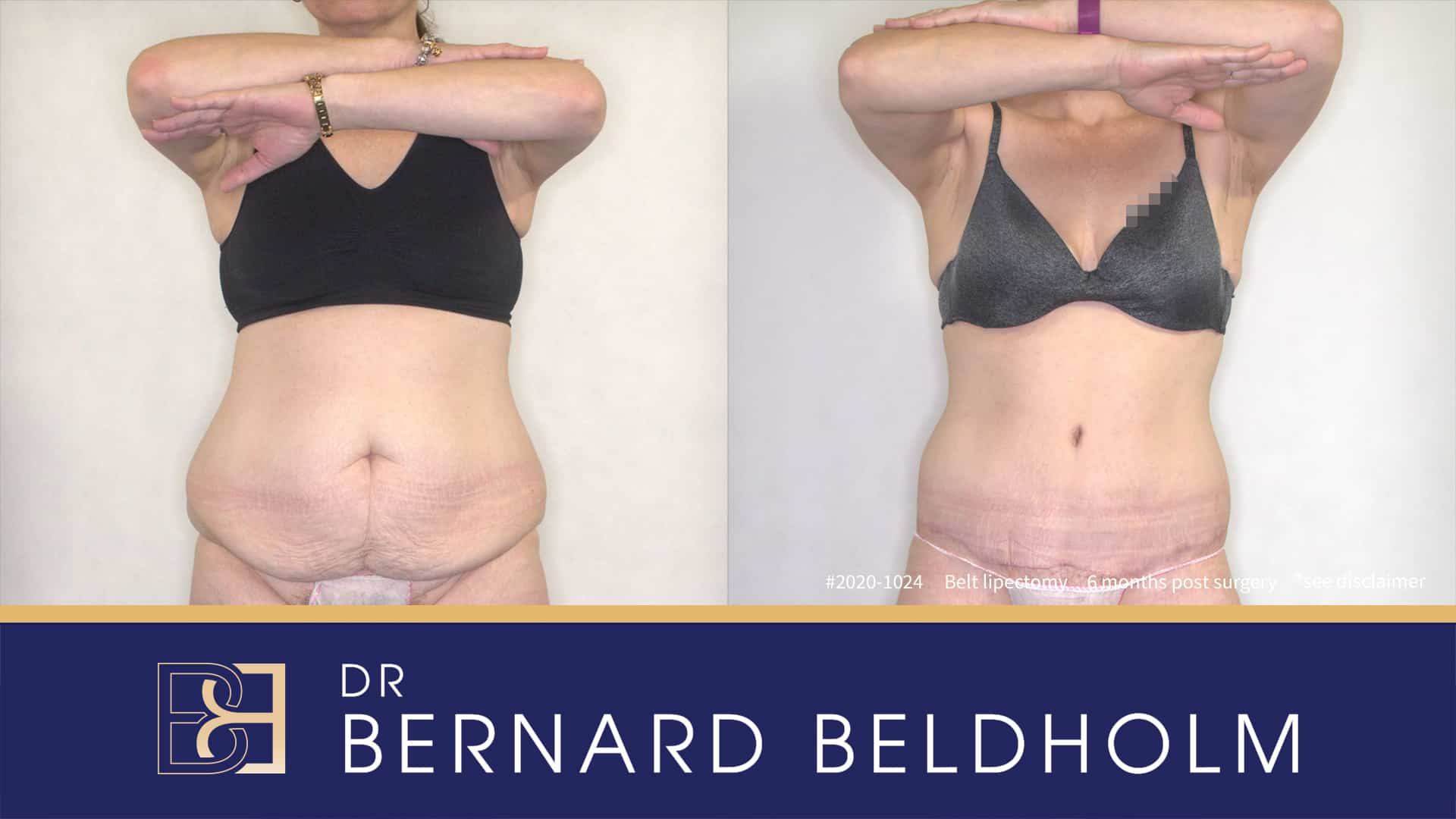 Patient 2020-1024 Belt Lipectomy (Body Lift) Post Weight Loss