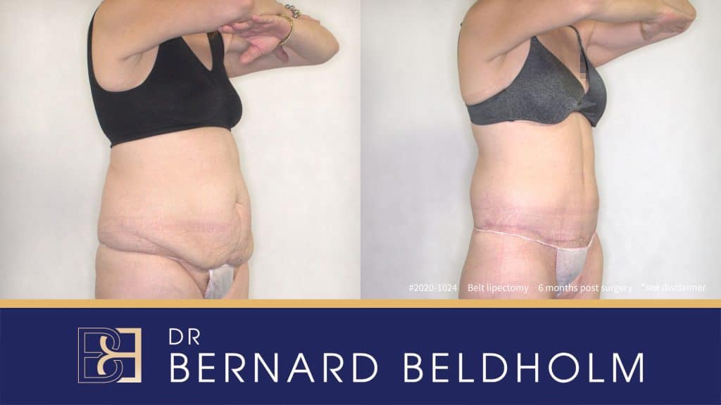 Belt Lipectomy (Body Lift) Post Weight Loss Patient 2020-1024