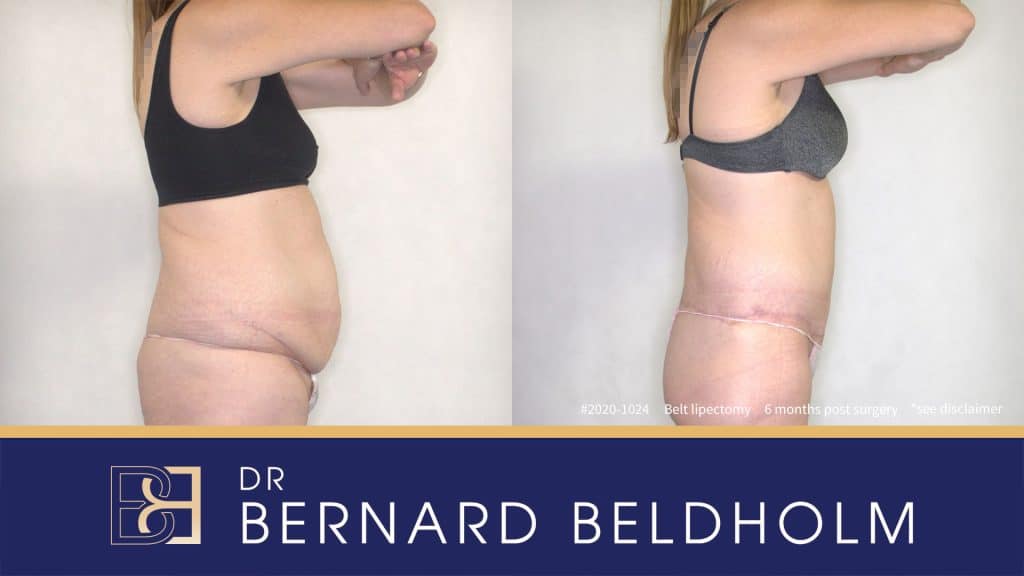 Belt Lipectomy (Body Lift) Post Weight Loss Patient 2020-1024