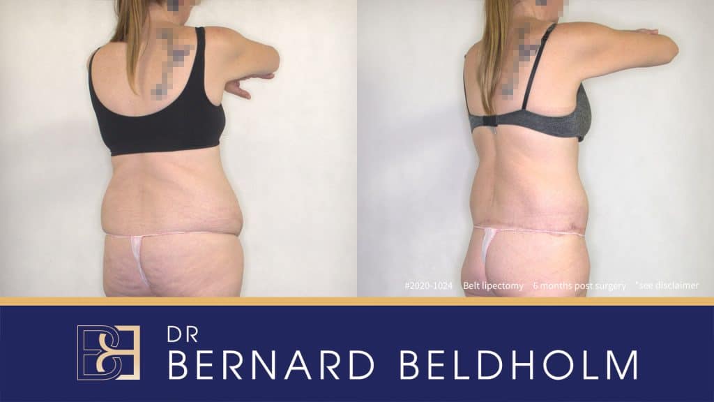 Belt Lipectomy (Body Lift) Post Weight Loss Patient 2020-1024