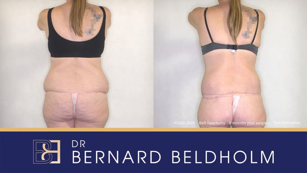 Belt Lipectomy (Body Lift) Post Weight Loss Patient 2020-1024
