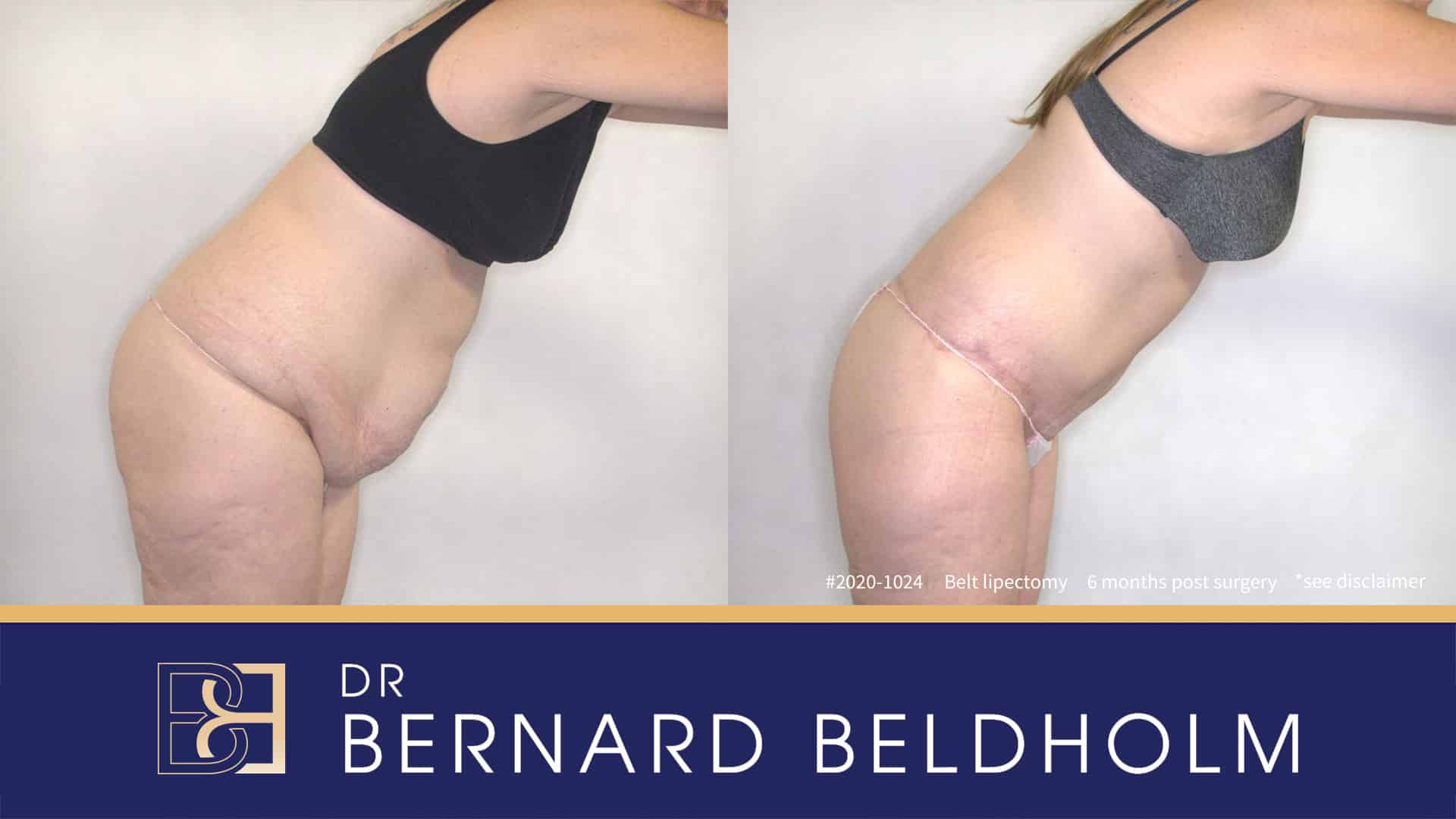 Belt Lipectomy (Body Lift) Post Weight Loss Patient 2020-1024