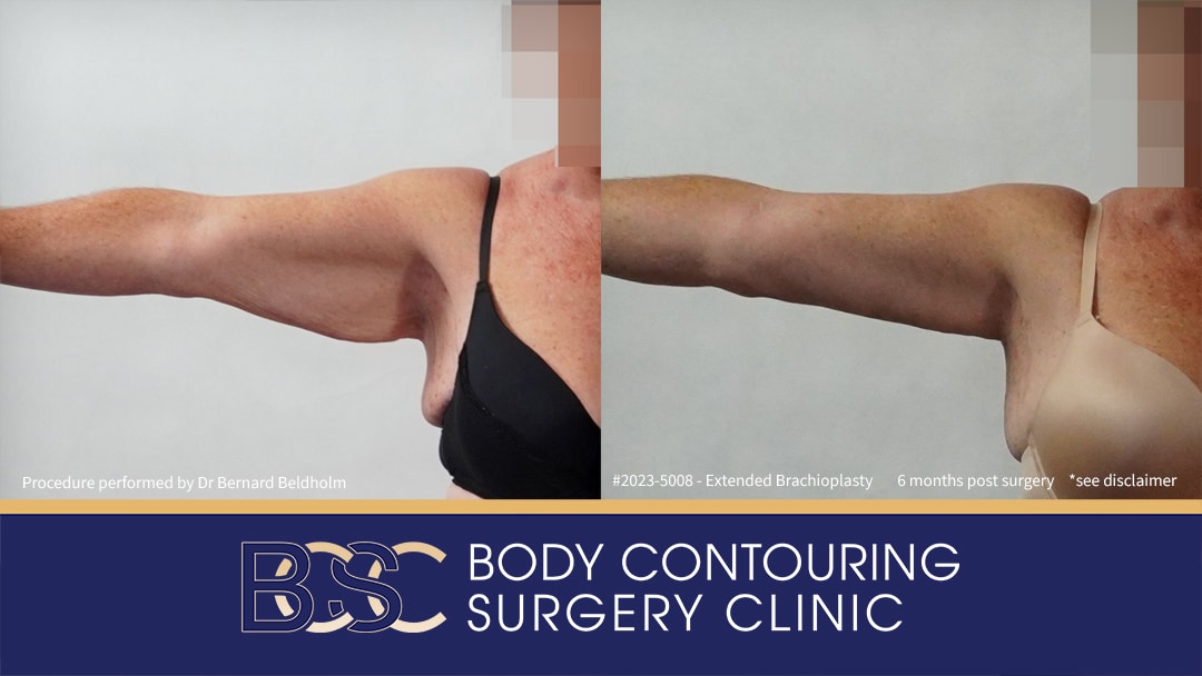 Patient 2023-5008 Brachioplasty with VASER Liposuction | 6 Months Post Surgery Before & After - Right