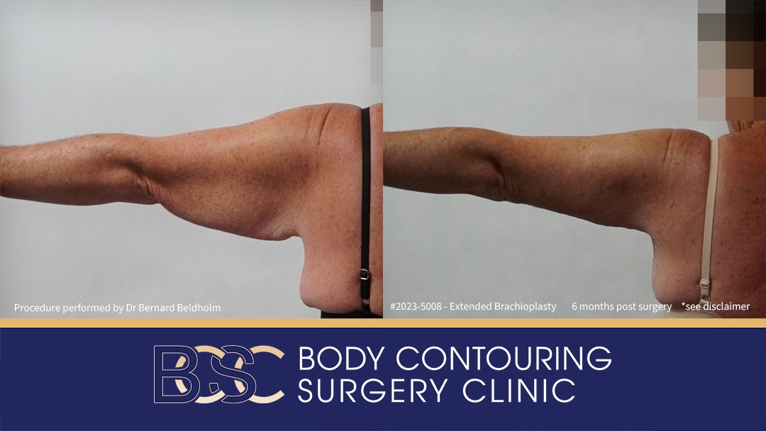 Patient 2023-5008 Brachioplasty with VASER Liposuction | 6 Months Post Surgery Before & After - Back