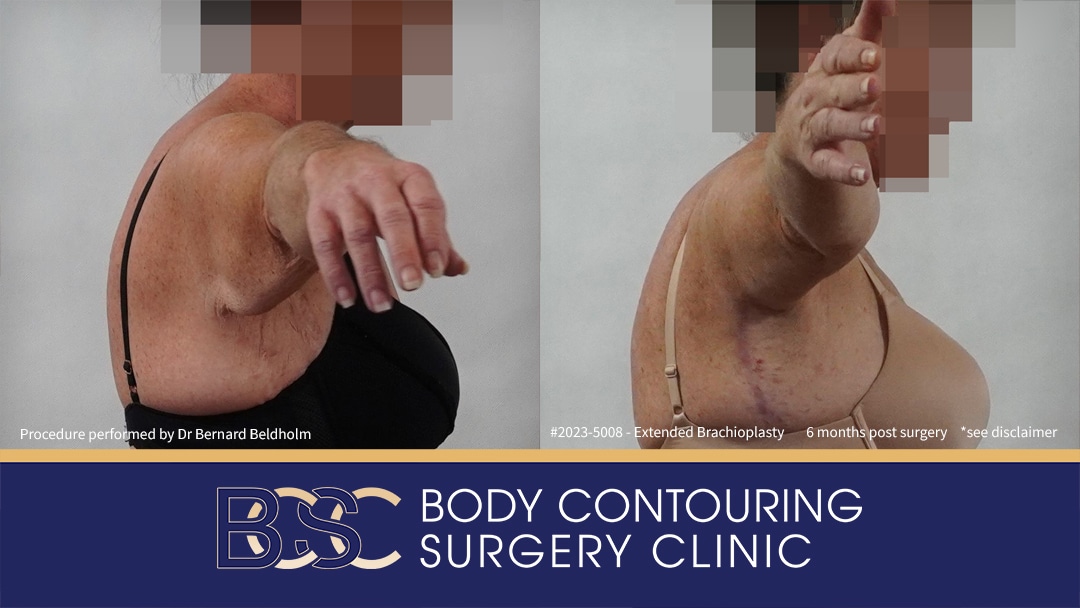 Patient 2023-5008 Brachioplasty with VASER Liposuction | 6 Months Post Surgery Before & After - Side