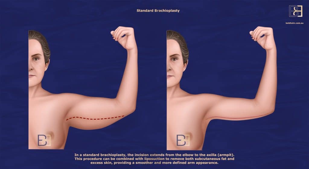 Full Brachioplasty (Standard Arm Lift)