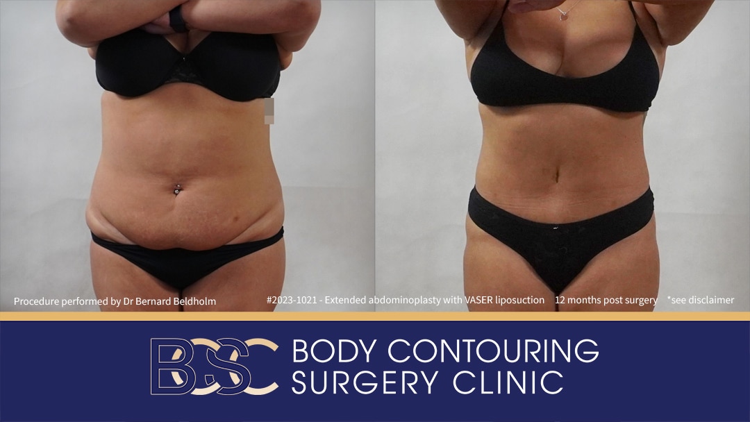 Patient 2023-1021 Extended Abdominoplasty Post Weight Loss with VASER Liposuction and Diastasis Recti Repair | 12 Months Post Surgery - Front