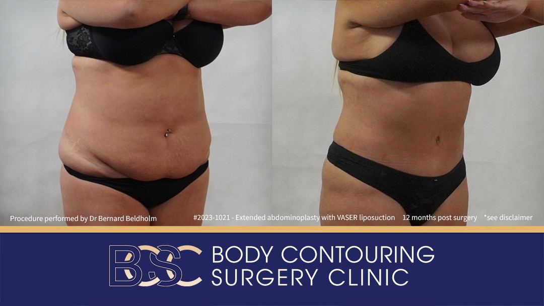 Patient 2023-1021 Extended Abdominoplasty Post Weight Loss with VASER Liposuction and Diastasis Recti Repair | 12 Months Post Surgery - Left