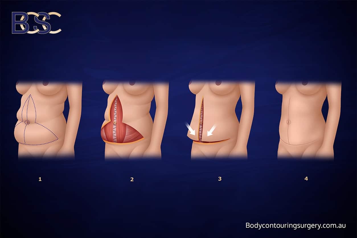 Fleur-de-Lis Abdominoplasty - Body Contouring Surgery Clinic Fleur-de-Lis Abdominoplasty - Body Contouring Surgery Clinic