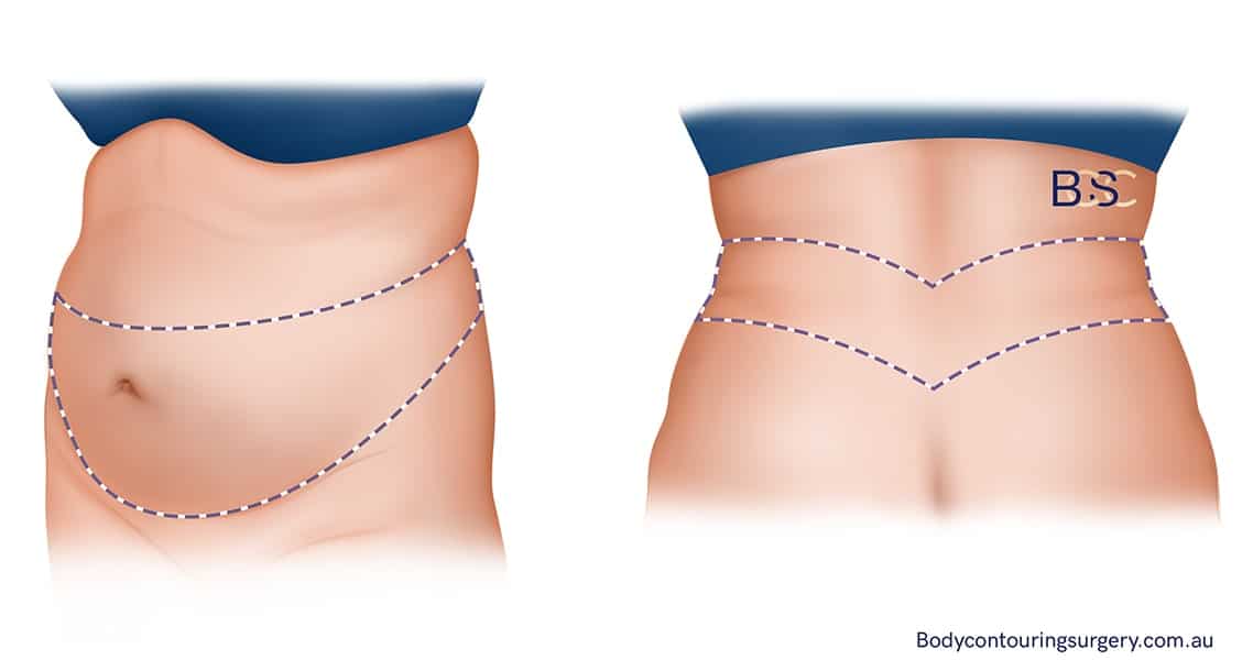 Circumferential Belt Lipectomy - Body Contouring Surgery Clinic Circumferential Belt Lipectomy