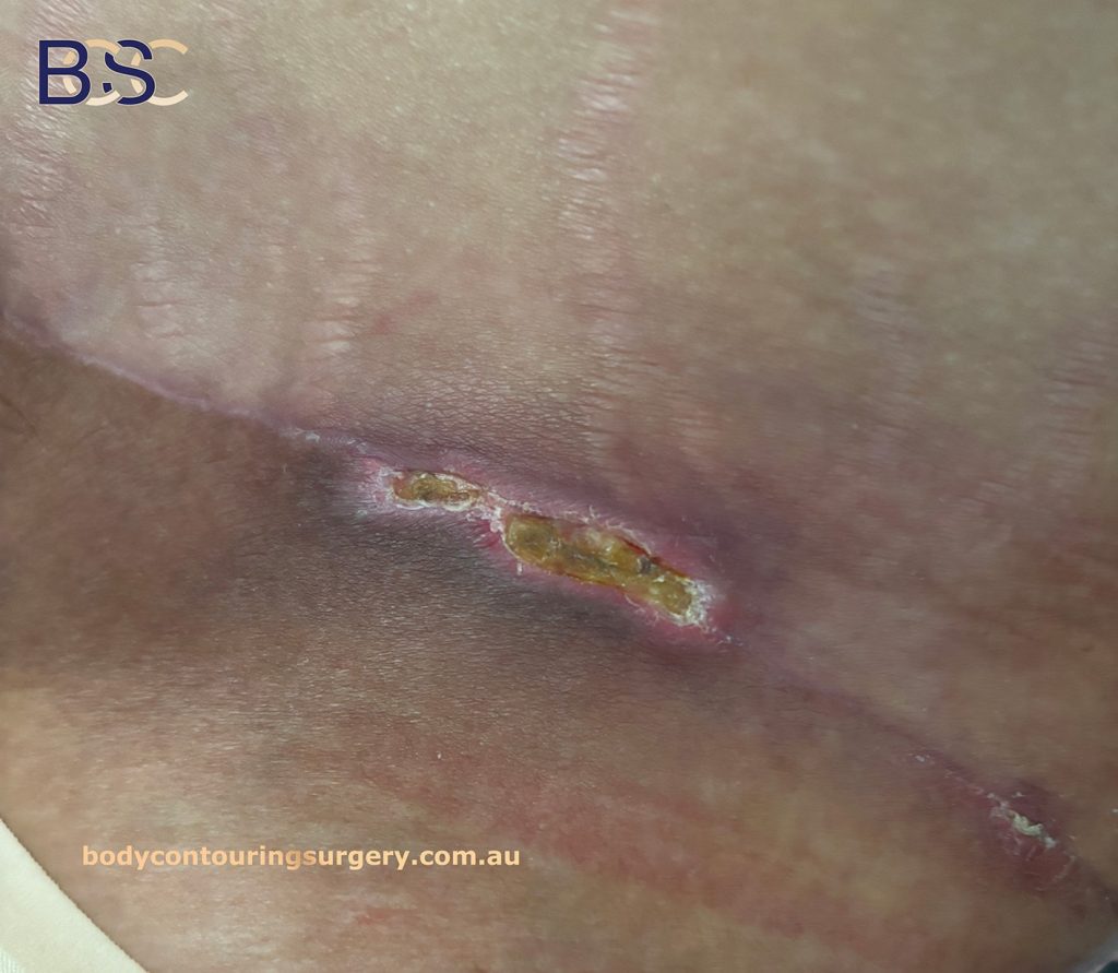 wound separation
